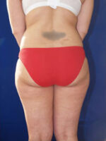 Liposuction