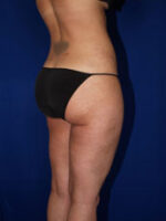Liposuction