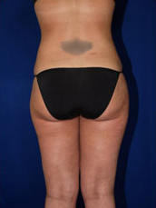 Liposuction