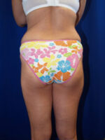 Liposuction