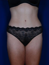 Liposuction