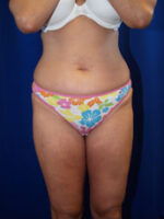 Liposuction