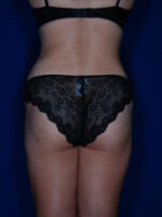 Liposuction