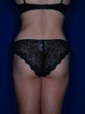 Liposuction