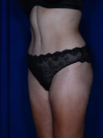 Liposuction