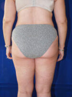 Liposuction