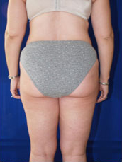 Liposuction