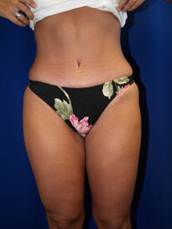Liposuction