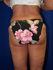 Liposuction