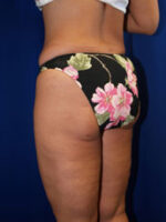 Liposuction