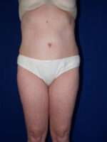 Liposuction