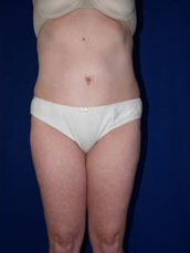 Liposuction