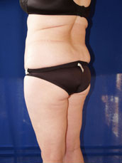 Liposuction