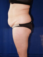 Liposuction