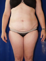 Liposuction