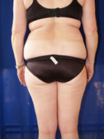 Liposuction