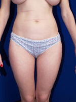 Liposuction