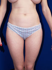 Liposuction