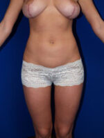 Liposuction