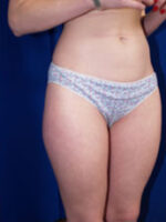 Liposuction