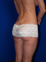 Liposuction