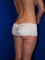 Liposuction