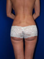 Liposuction