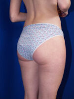 Liposuction