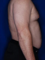 Male Liposuction