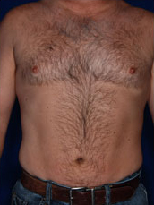 Male Liposuction