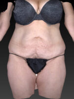Abdominoplasty