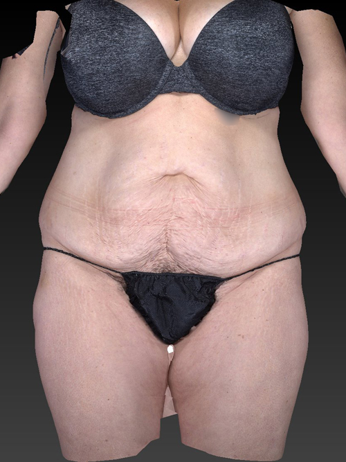 Abdominoplasty