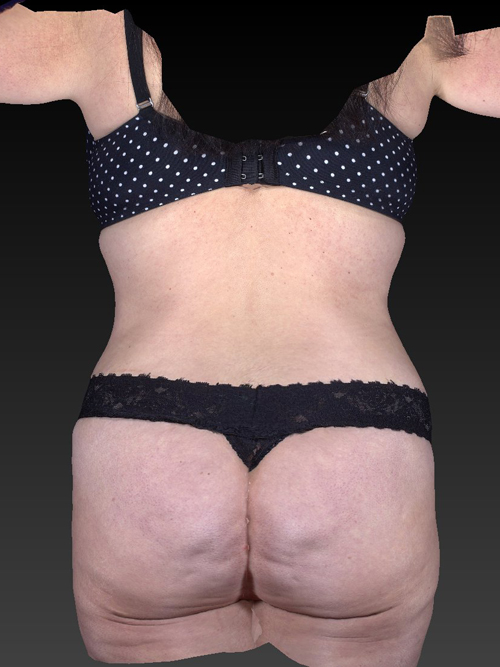 Brazilian & Fat Transfer Butt Lift