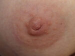 Inverted Nipple Correction