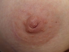 Inverted Nipple Correction
