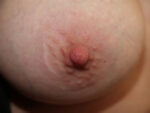 Inverted Nipple Correction