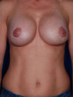 Revisional Breast Augmentation