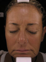Skin Resurfacing/Rejuvenation