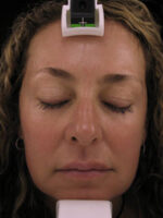 Skin Resurfacing/Rejuvenation