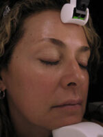 Skin Resurfacing/Rejuvenation