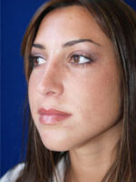 Rhinoplasty