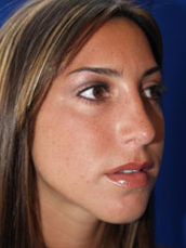 Rhinoplasty
