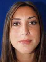 Rhinoplasty