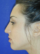 Rhinoplasty