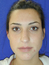 Rhinoplasty