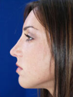 Rhinoplasty