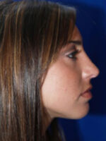 Rhinoplasty