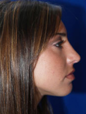 Rhinoplasty