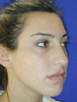 Rhinoplasty