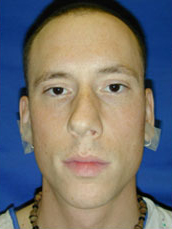 Rhinoplasty